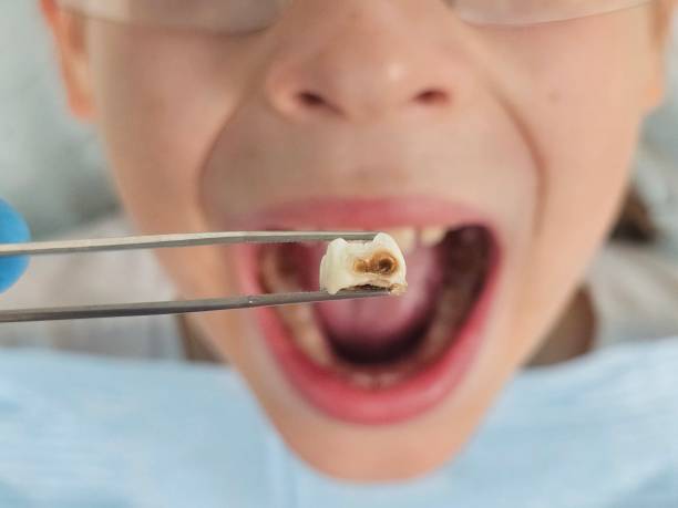 Best Root Canal Emergency Dentist  in Carrington, ND